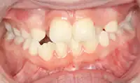 Before treatment: Private orthodontics with bonding to Improve shape of teeth on completion.