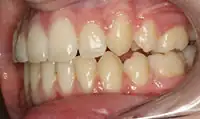 After treatment: Six month smiles: Short term orthodontics with tooth whitening