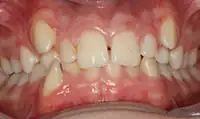 Before treatment: Six month smiles: Short term orthodontics with tooth whitening