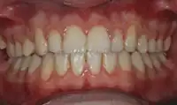 After treatment: Six month smiles: Short term orthodontics with tooth whitening