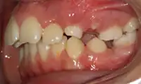 Before treatment: Six month smiles: Short term orthodontics with tooth whitening