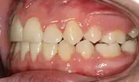 After treatment: Six month smiles: Short term orthodontics with tooth whitening