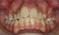 Before treatment: Six month smiles: Short term orthodontics with tooth whitening