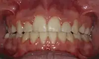 After treatment: Six month smiles: Short term orthodontics with tooth whitening