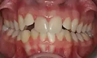 Before treatment: Six month smiles: Short term orthodontics with tooth whitening