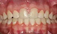 After treatment: Six month smiles: Short term orthodontics with tooth whitening