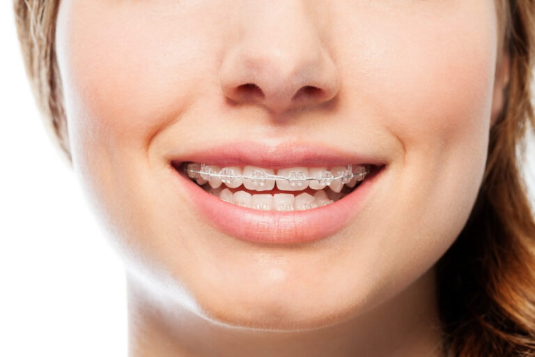 Orthodontics 101: How Best to Look After Your Braces