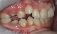 Before treatment: Six month smiles: Short term orthodontics with tooth whitening