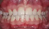After treatment: Private orthodontics with bonding to Improve shape of teeth on completion.