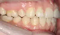 After treatment: Six month smiles: Short term orthodontics with tooth whitening
