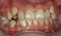 Before treatment: Six month smiles: Short term orthodontics with tooth whitening