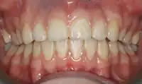 After treatment: Six month smiles: Short term orthodontics with tooth whitening