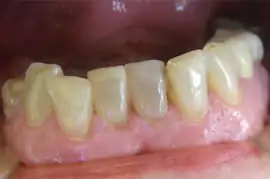 Before treatment: Six month smiles: Short term orthodontics with tooth whitening