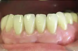 After treatment: Six month smiles: Short term orthodontics with tooth whitening