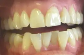Before treatment: Six month smiles: Short term orthodontics with tooth whitening