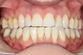 After treatment: Six month smiles: Short term orthodontics with tooth whitening