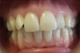 Before treatment: Six month smiles, 9months