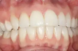 After treatment: Six month smiles, 9months
