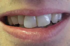 Before treatment: Crown and bridge work