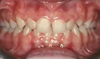 Before treatment: NHS Fixed orthodontic treatment
