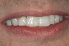 After treatment: Crown and bridge work