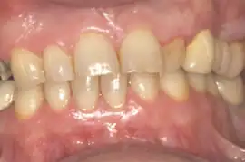 Before treatment: Six month smiles: Adult cosmetic braces 4-9 months followed by tooth whitening