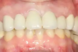 After treatment: Six month smiles: Adult cosmetic braces 4-9 months followed by tooth whitening
