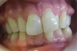 Before treatment: Implant placed in upper left central incisor position