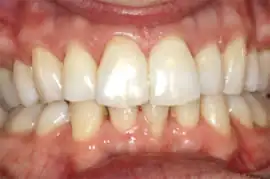After treatment: Implant placed in upper left central incisor position