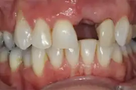 Before treatment: Improve your smile with tooth whitening and veneers
