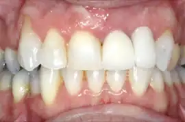 After treatment: Improve your smile with tooth whitening and veneers