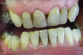 Before treatment: Implant supported crown placed in Upper left central incisor position