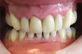 After treatment: Implant supported crown placed in Upper left central incisor position