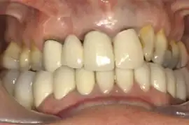 Before treatment: Short term orthodontics with tooth whitening
