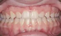After treatment: NHS Fixed orthodontic treatment
