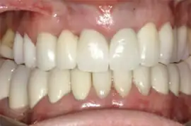 After treatment: Short term orthodontics with tooth whitening