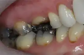 Before treatment: Short term orthodontics with tooth whitening