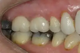 After treatment: Short term orthodontics with tooth whitening