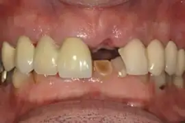 Before treatment: Short term orthodontics with tooth whitening