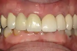 After treatment: Short term orthodontics with tooth whitening