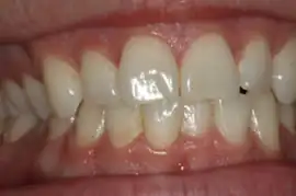 Before treatment: Short term orthodontics with tooth whitening