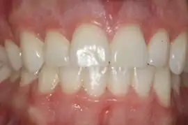 After treatment: Short term orthodontics with tooth whitening