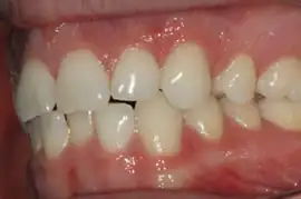 Before treatment: Implant supported bridge in upper right premolar region
