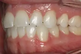 After treatment: Implant supported bridge in upper right premolar region