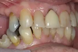 Before treatment: Implant supported bridges in upper premolar areas