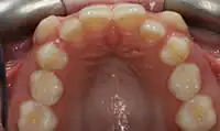 Before treatment: Natural looking crown and bridge work