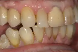 After treatment: Implant supported bridges in upper premolar areas