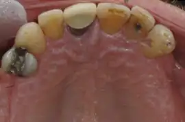 Before treatment: Fully comprehensive orthodontics