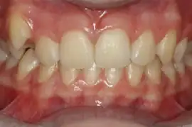 Before treatment: Fully comprehensive orthodontics