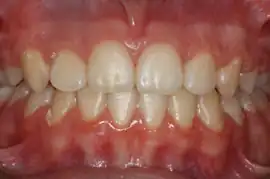 After treatment: Fully comprehensive orthodontics